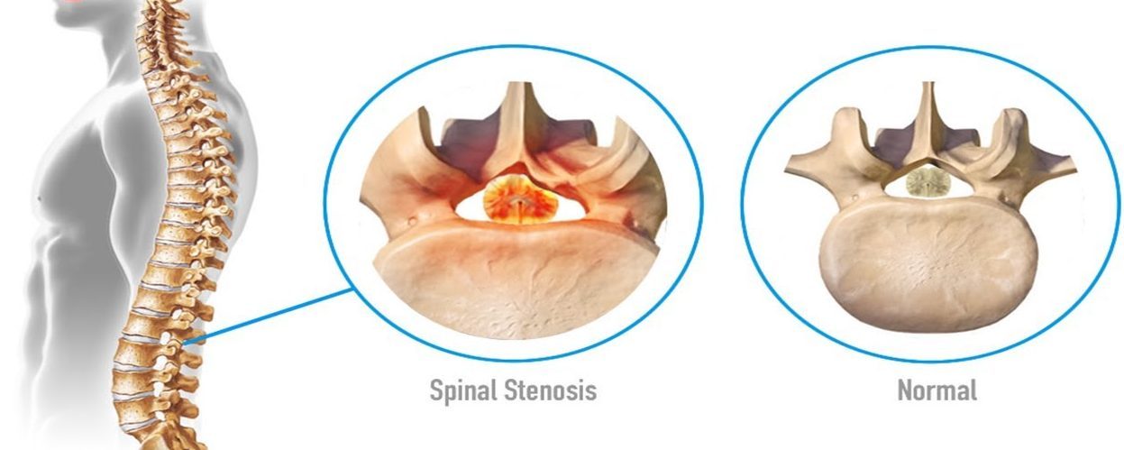 Spinal Stenosis Causes