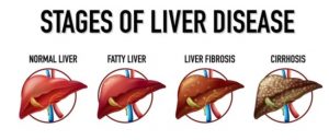 Fatty Liver Disease Is a Ticking Time Bomb: Get Yourself Examined Today