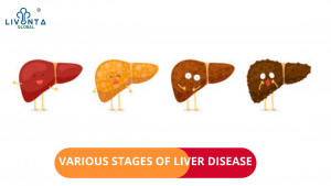 VARIOUS STAGES OF LIVER DISEASE