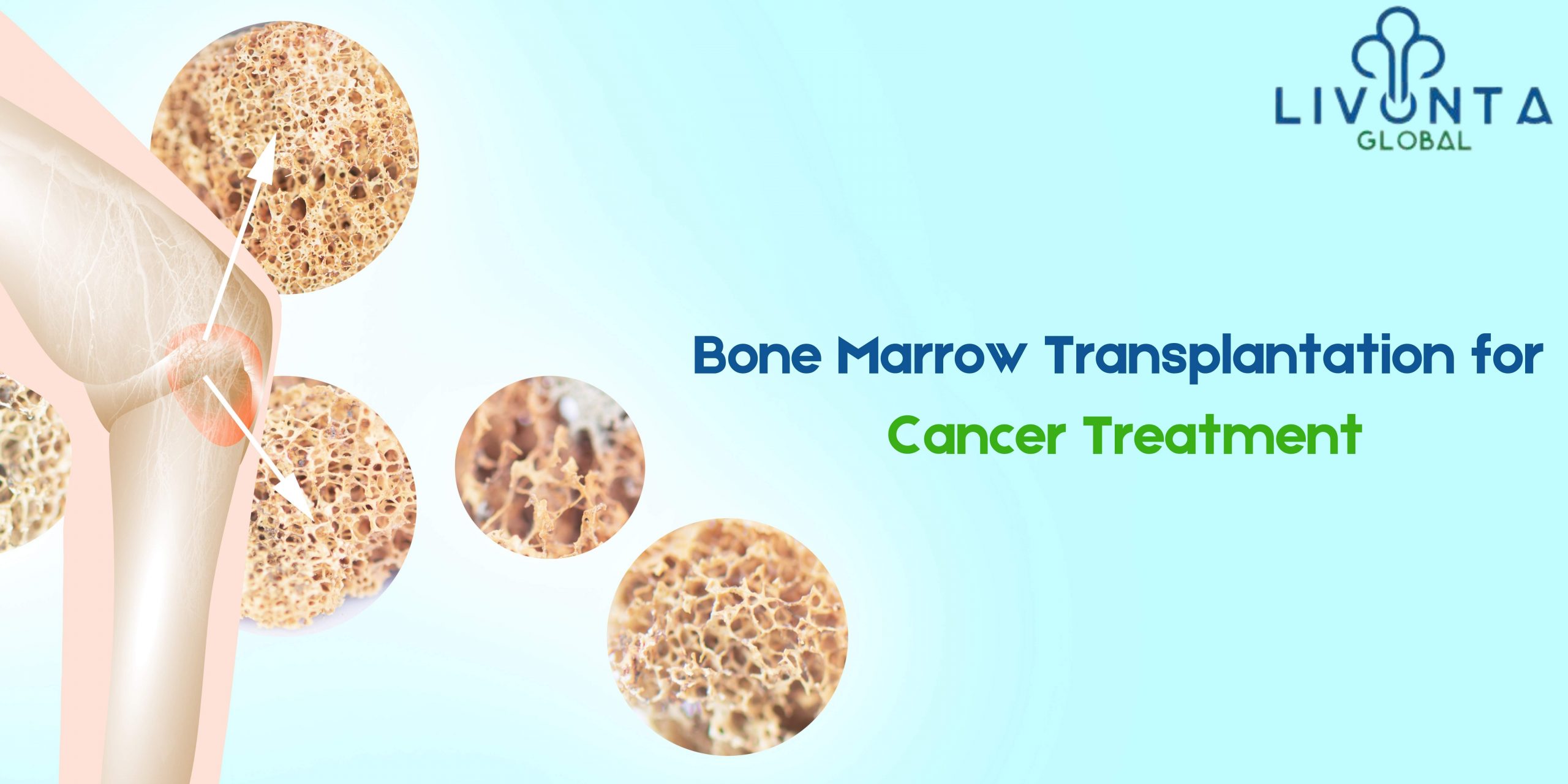 Bone Marrow Transplantation for Cancer Treatment