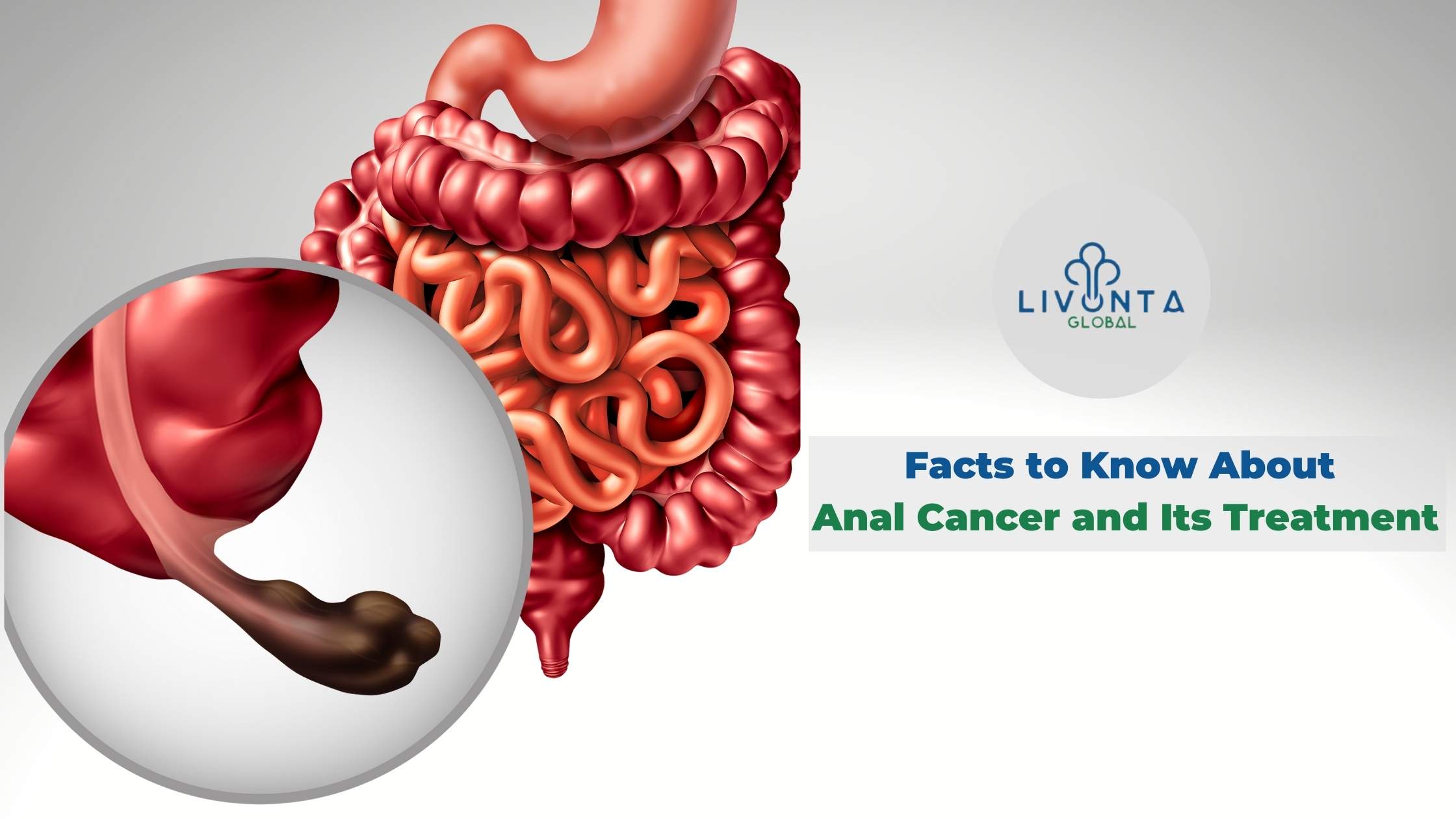 Facts to Know About Anal Cancer and Its Treatment