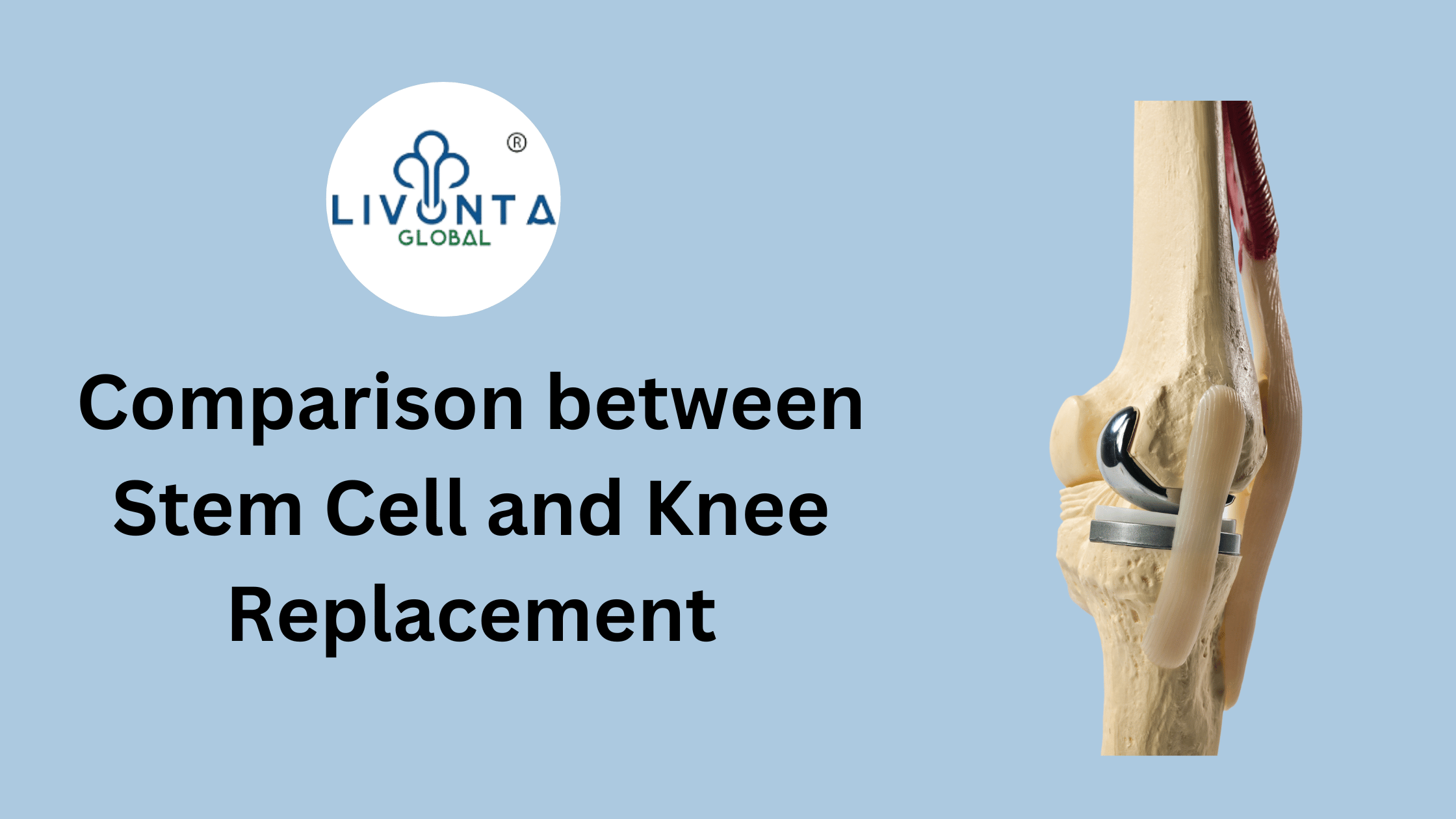 Comparison between Stem Cell and Knee Replacement