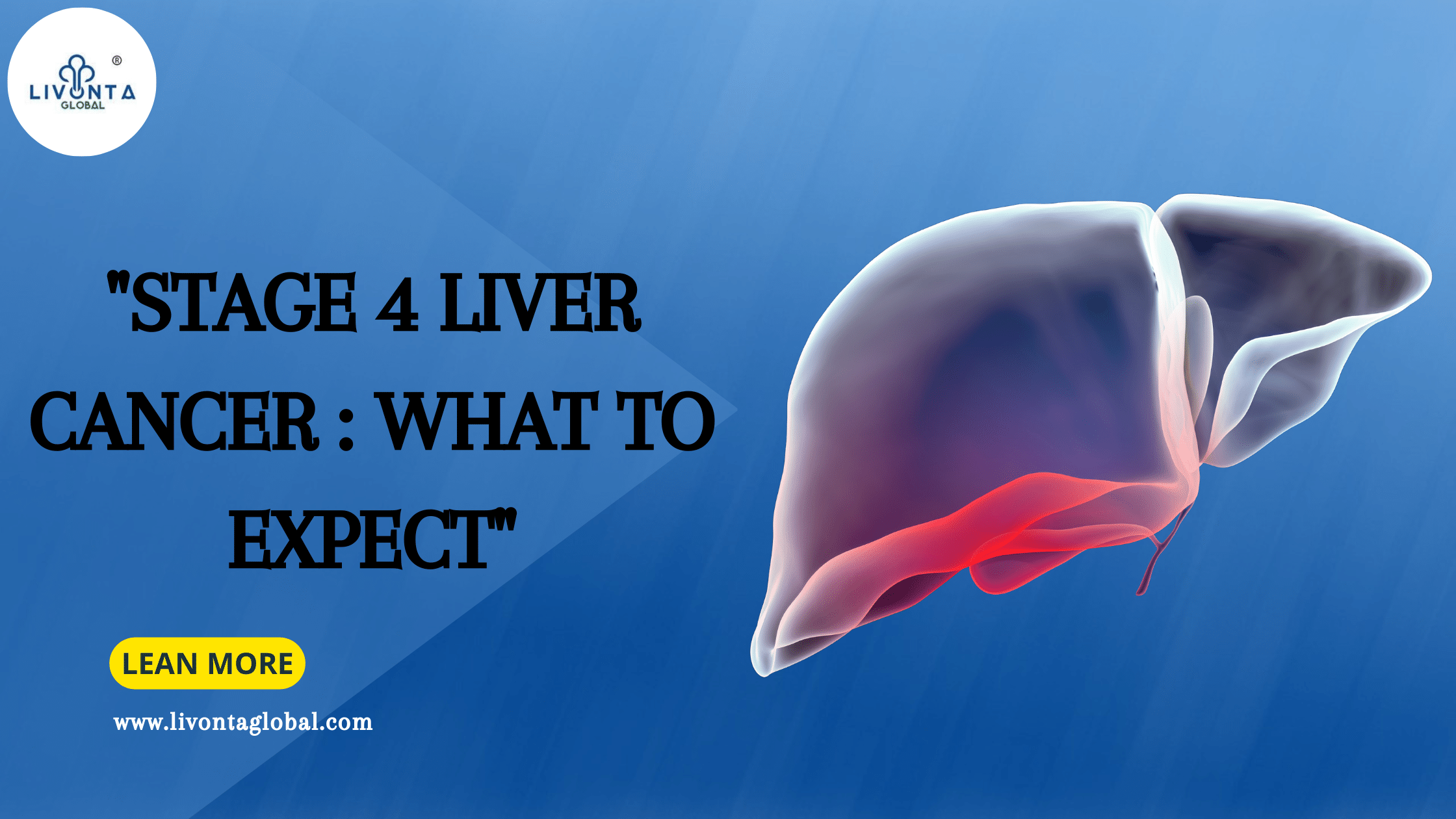 "Stage 4 Liver Cancer: What to Expect"