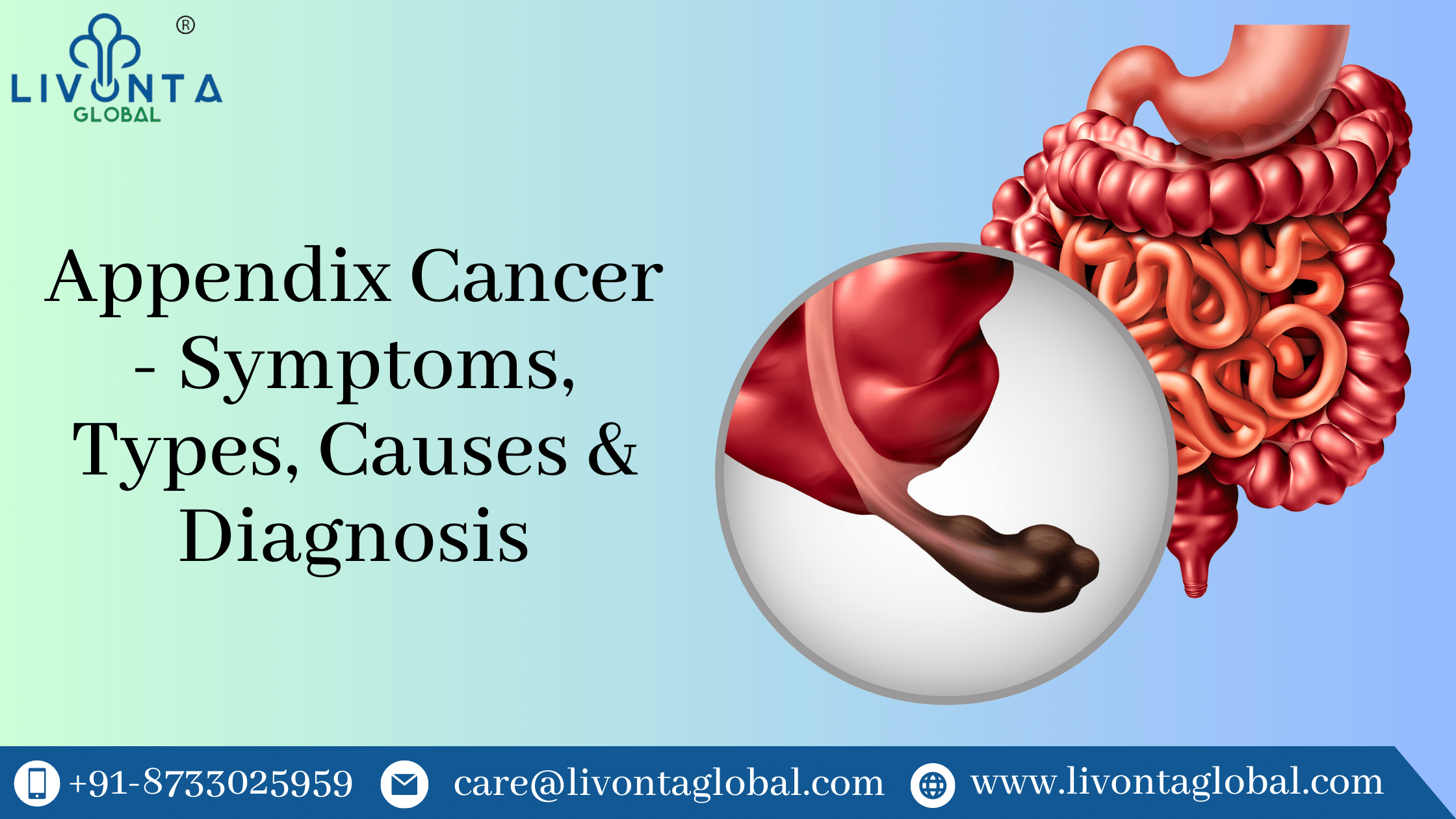 Appendix Cancer - Symptoms, Types, Causes & Diagnosis
