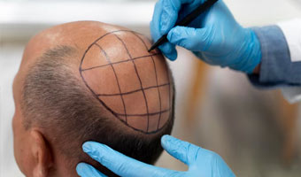 Hair Transplant (FUE & Sapphire techniques) (Turkey)