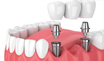 Dental Implants (Thailand)