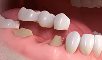 Prosthodontics (Turkey)