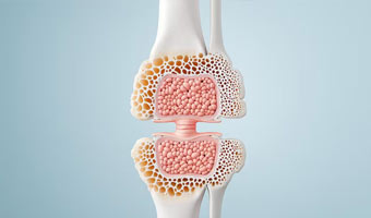 Bone Marrow & Stem Cell Transplant (Selective Centers) (UAE)